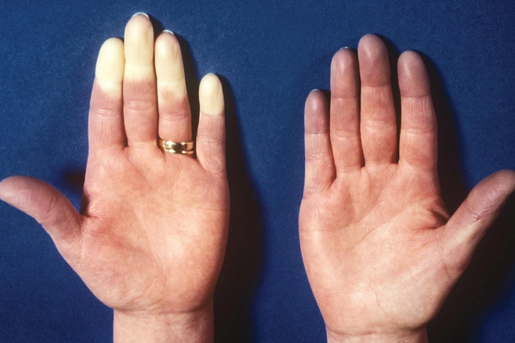 Raynaud’s Disease Raynaud’s Disease