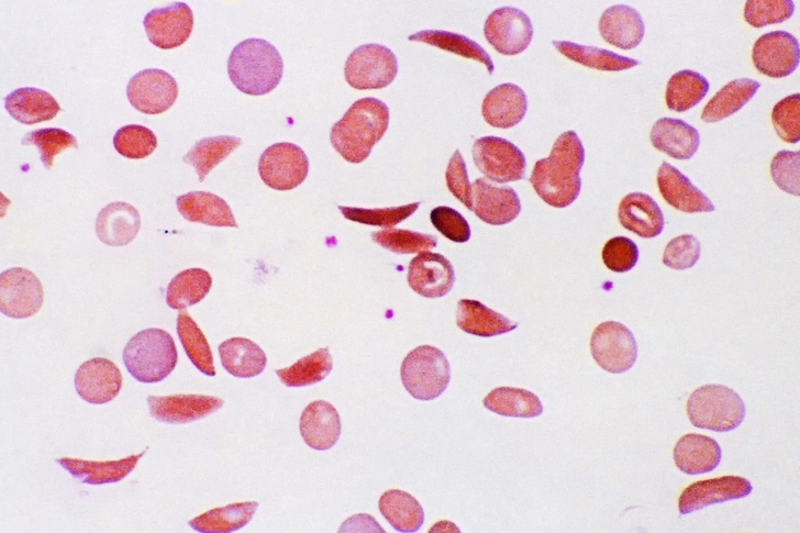 Sickle Cell Disease Sickle Cell Disease