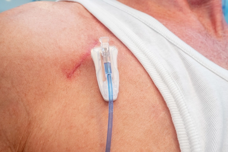 Cancer and Cancer Treatment Cancer and Cancer Treatment