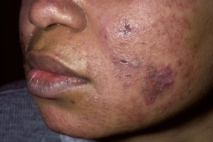 Lupus