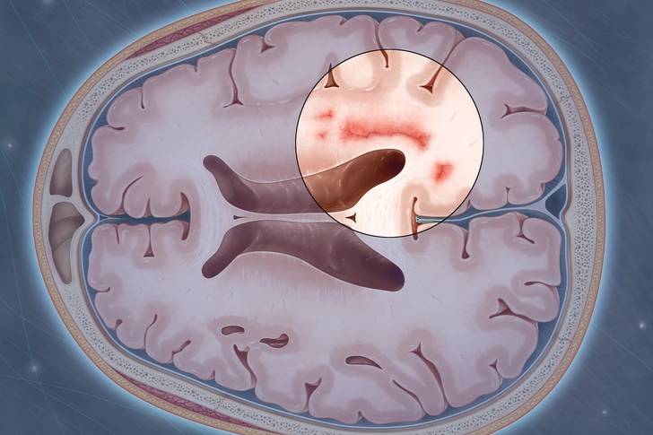Multiple Sclerosis (MS) Multiple Sclerosis (MS)