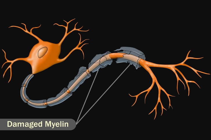 Multiple Sclerosis (MS)