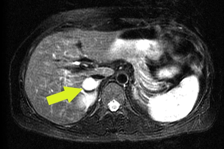 Pheochromocytoma