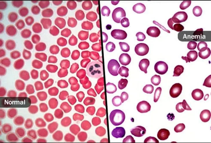 Anemia
