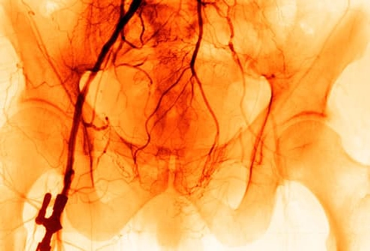 Peripheral Artery Disease Peripheral Artery Disease