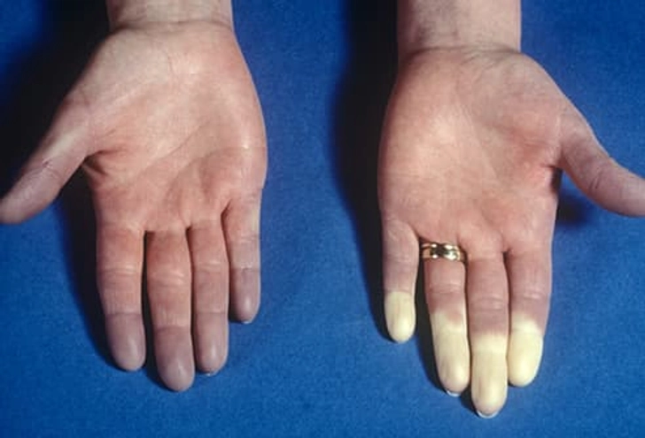 Raynaud's Phenomenon Raynaud's Phenomenon