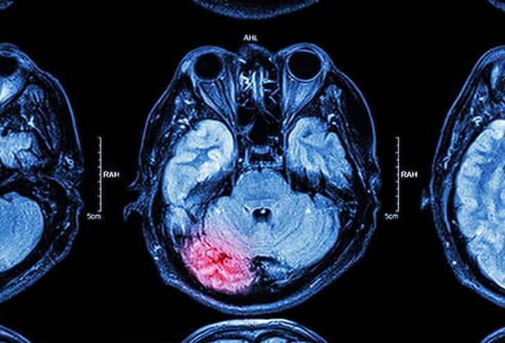 Concussion Concussion