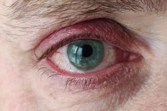 “Heavy” Eyelids