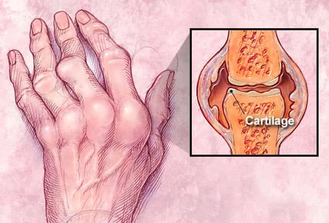 Nó ảnh hưởng đến khớp như thế nào? Nó ảnh hưởng đến khớp như thế nào?