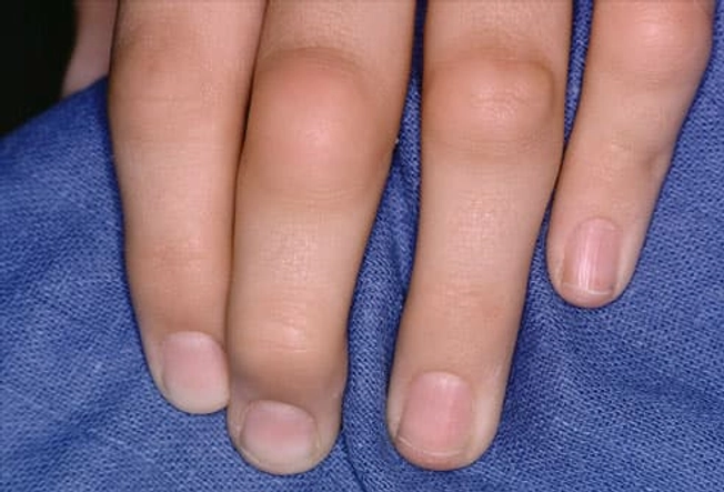 Các triệu chứng là gì? Các triệu chứng là gì?