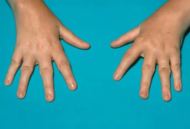 Viêm khớp dạng thấp ở trẻ em (JRA) là gì? Viêm khớp dạng thấp ở trẻ em (JRA) là gì?
