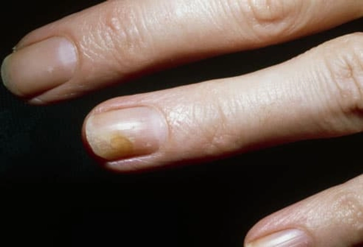 Ringworm of the Nails (Tinea Unguium)