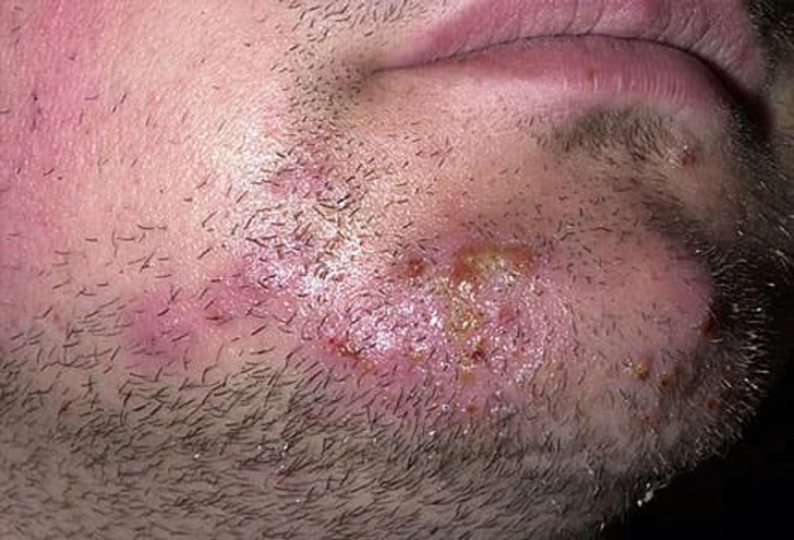 Ringworm of the Beard (Tinea Barbae)