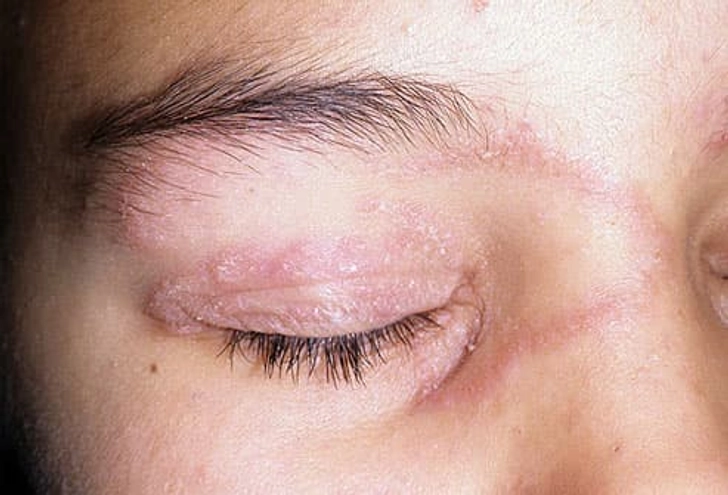 Ringworm of the Face (Tinea Faciei)