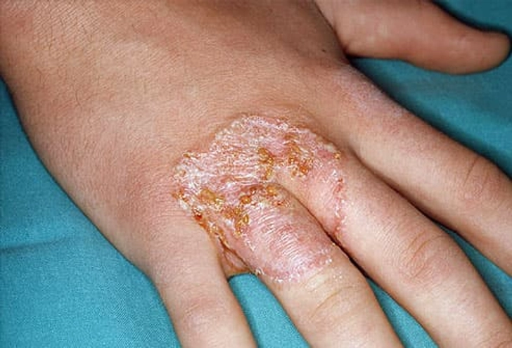 Ringworm of the Hand (Tinea Manuum)