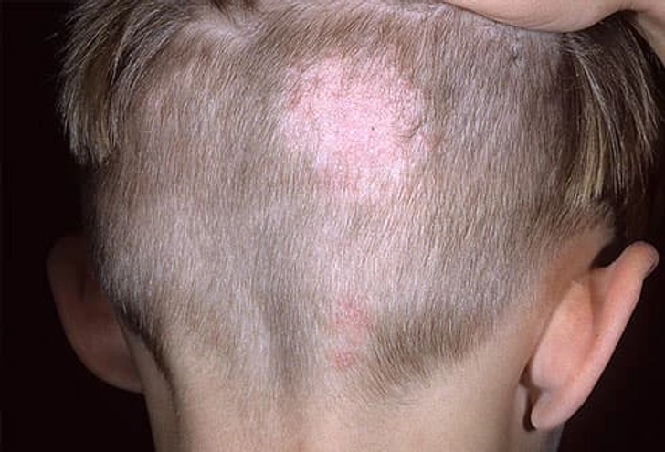 Ringworm of the Scalp (Tinea Capitis)