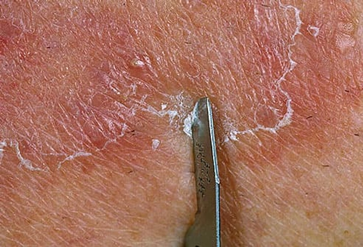 How Is Ringworm Diagnosed?