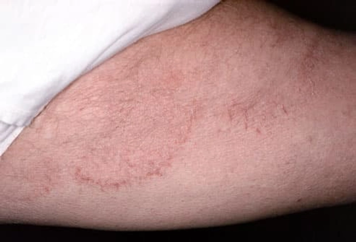 Ringworm of the Groin (Tinea Cruris)