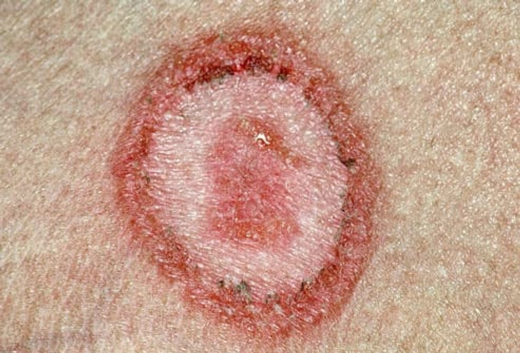 Ringworm of the Body (Tinea Corporis)