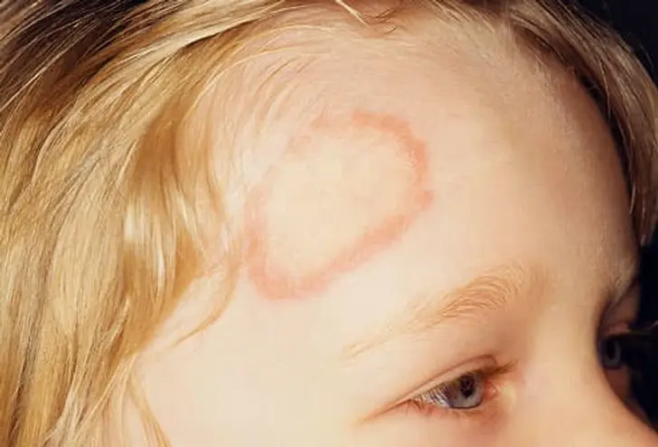 What Is Ringworm?