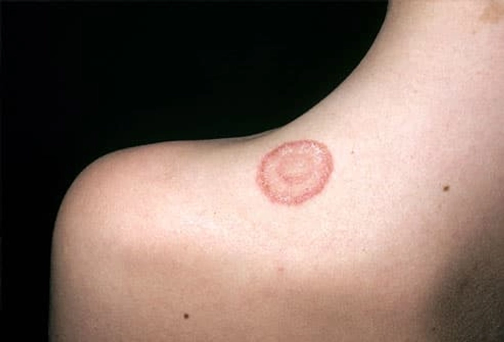 Does Ringworm Mean I Have Worms? Does Ringworm Mean I Have Worms?