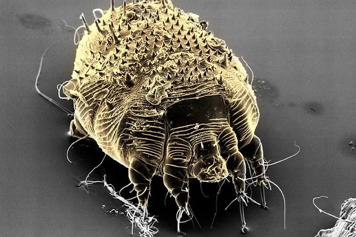 What Is Scabies?