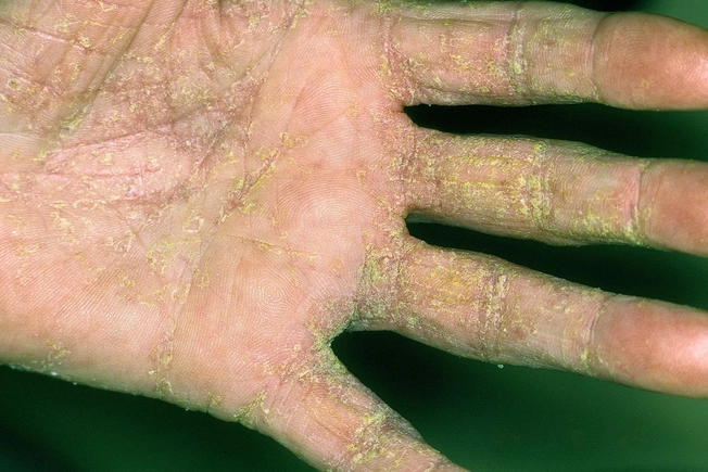 Crusted Scabies