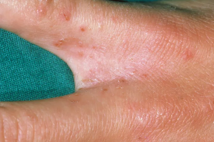 Scabies Pictures Of Rash Mites Symptoms Treatment Scabies Pictures Of Rash Mites Symptoms Treatment