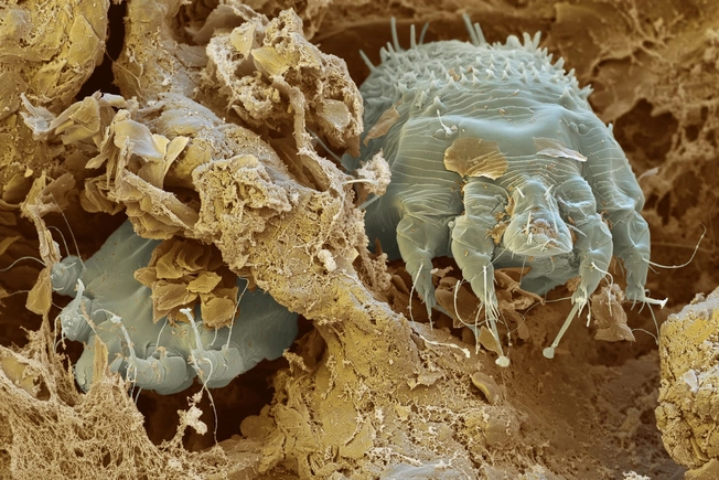 Can Scabies Mites Be Seen?