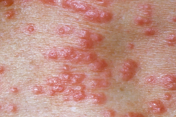 Scabies Symptoms Scabies Symptoms