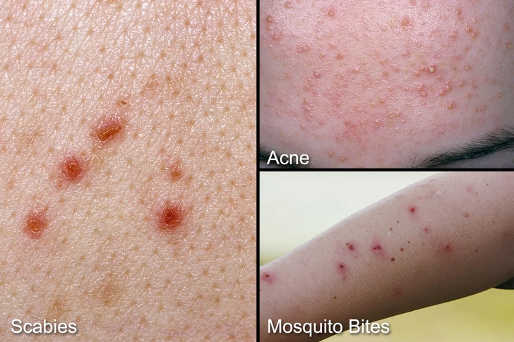 Scabies or Something Else? Scabies or Something Else?