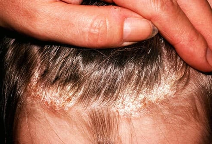 Symptom: Dry and Flaky Scalp