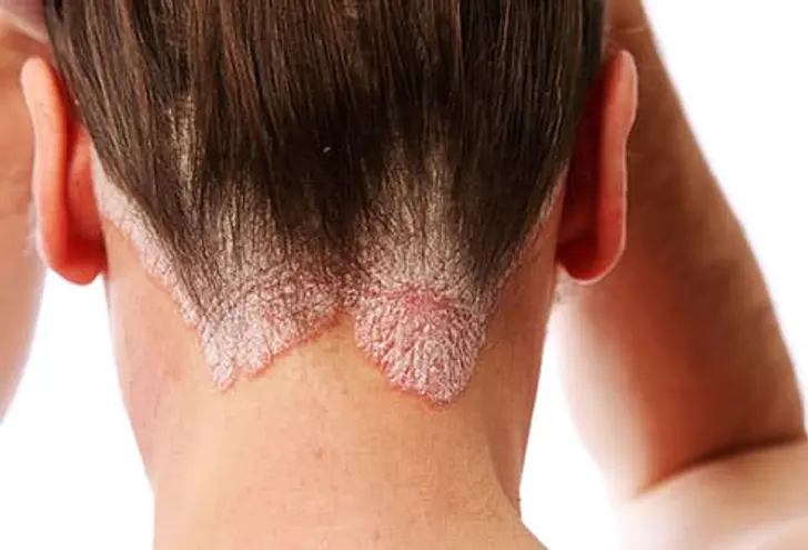 What Is Scalp Psoriasis? What Is Scalp Psoriasis?