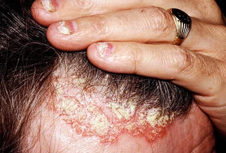 Symptom: Red and White Patches Symptom: Red and White Patches
