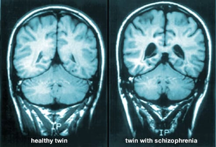 What Causes It?
