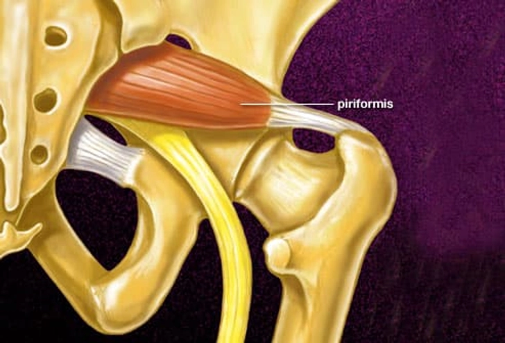 Cause: Piriformis Syndrome