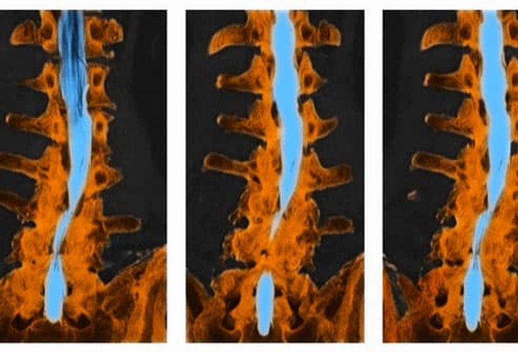 Cause: Spinal Stenosis