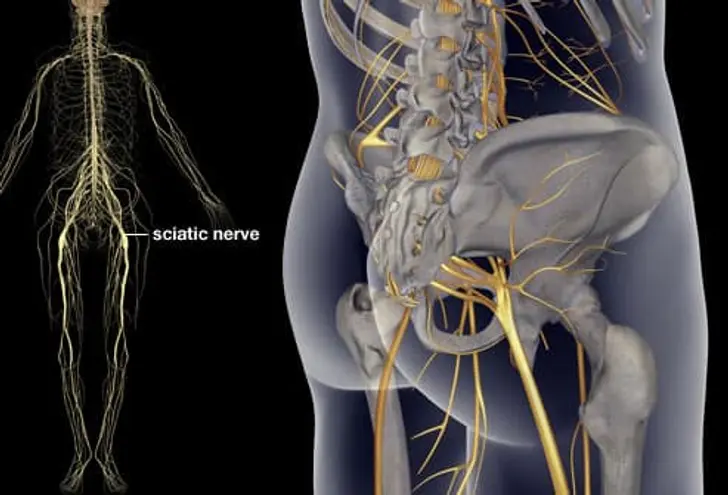 What Is Sciatica? What Is Sciatica?