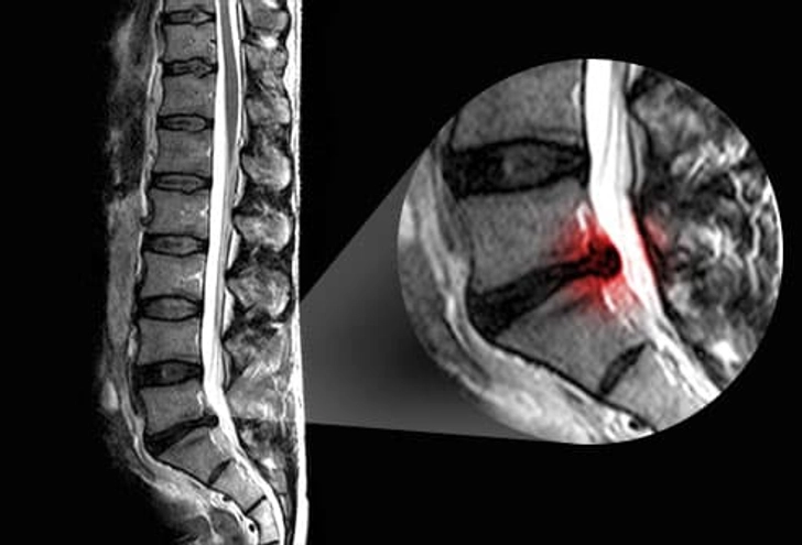 Cause: Herniated Disk