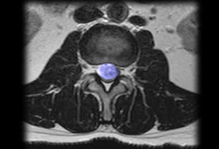 Cause: Spinal Tumors