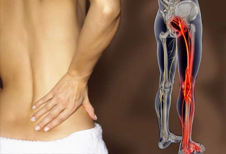 Symptoms of Sciatica Symptoms of Sciatica