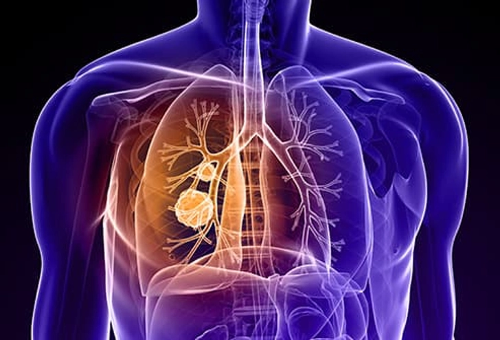 Lung Cancer