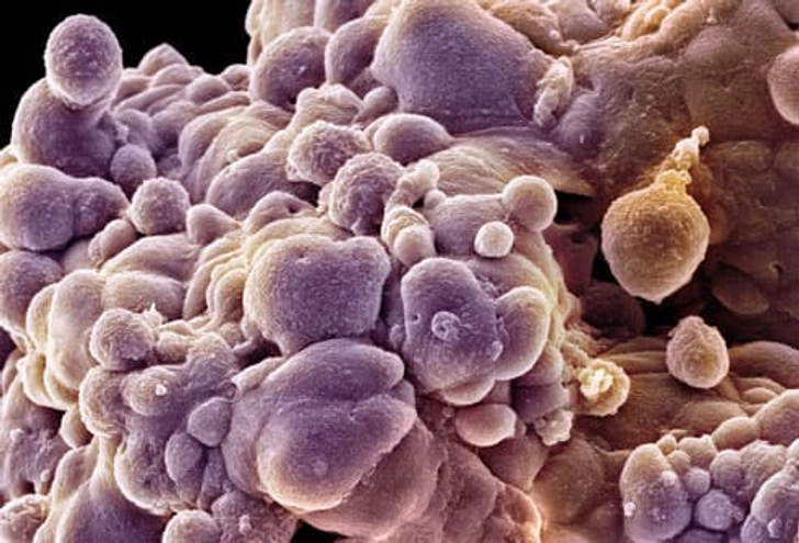 Prostate Cancer