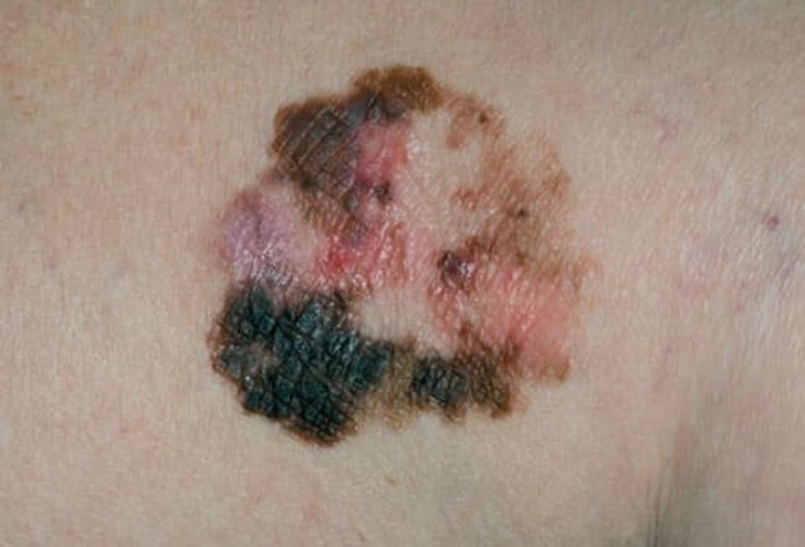 Skin Cancer Skin Cancer