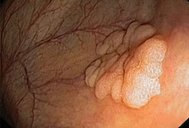 Colorectal Cancer Colorectal Cancer
