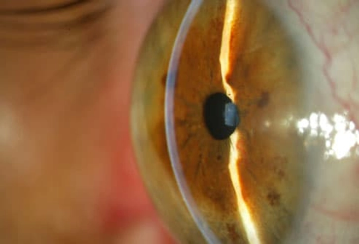 Glaucoma Glaucoma