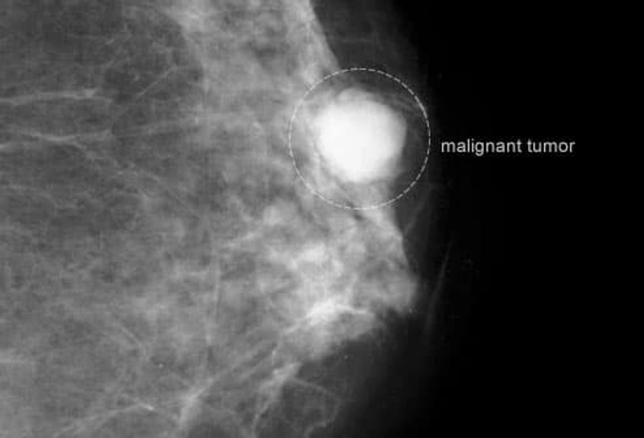 Breast Cancer Breast Cancer