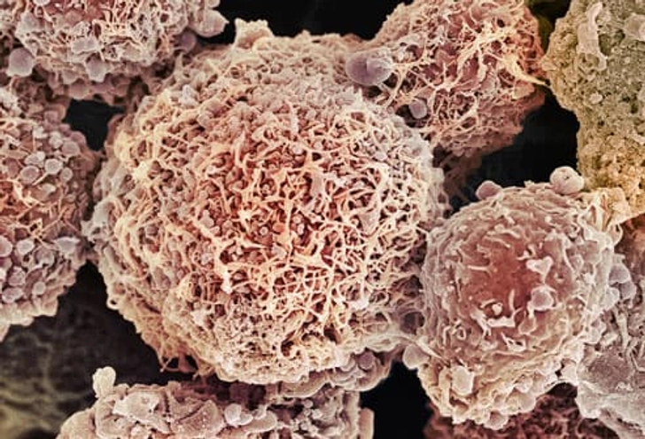 Cervical Cancer Cervical Cancer