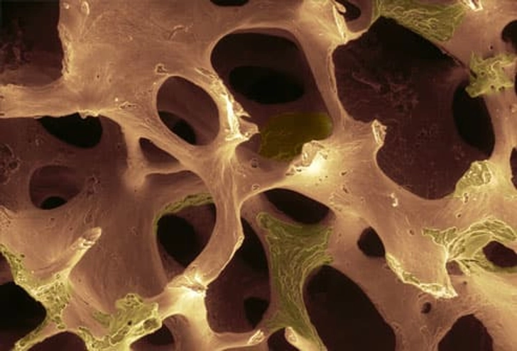 Osteoporosis and Fractured Bones Osteoporosis and Fractured Bones