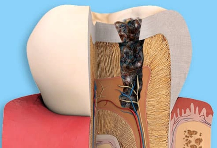 Tooth Decay
